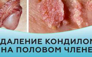 Папилломы на половом члене
