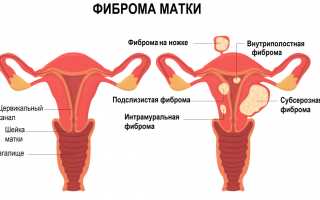 Что такое фиброма