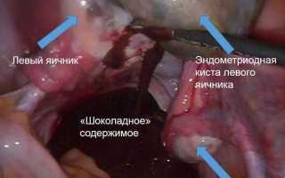 Киста яичника при беременности