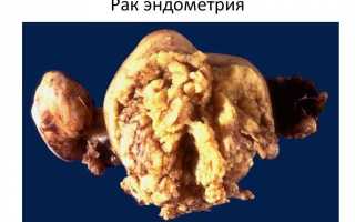Является ли гиперплазия эндометрия матки раком