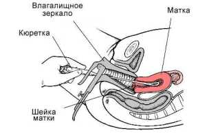 Диагностика эндометриоза матки