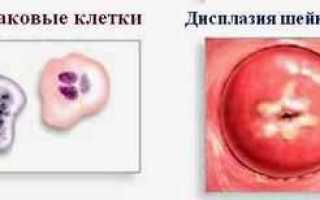 Ампутация шейки матки при 3 степени дисплазии