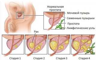 Карцинома предстательной железы