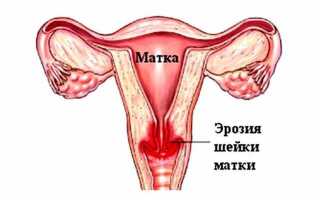 Выделения и сгустки крови из матки