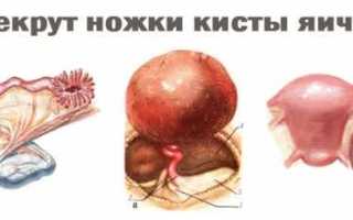 Геморрагическая киста яичника