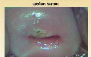 Лечение простой лейкоплакии шейки матки