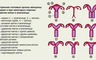 Две матки и две шейки матки