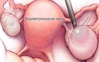 Киста яичника: это рак или нет