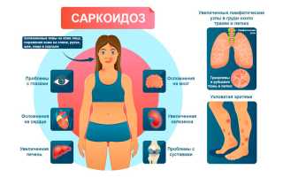 Можно ли отдыхать на море при саркоидозе легких