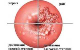 Конус шейки матки после конизации