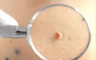 Чем лечить папилломы на теле
