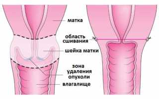 Последствия после удаления матки и шейки матки
