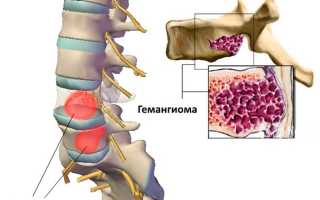 Гемангиома позвоночника