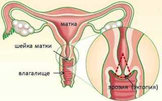 Лечение варикозного расширения вен матки