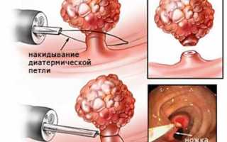 Железисто-фиброзный полип